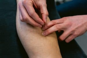 FysioVars Dry Needling